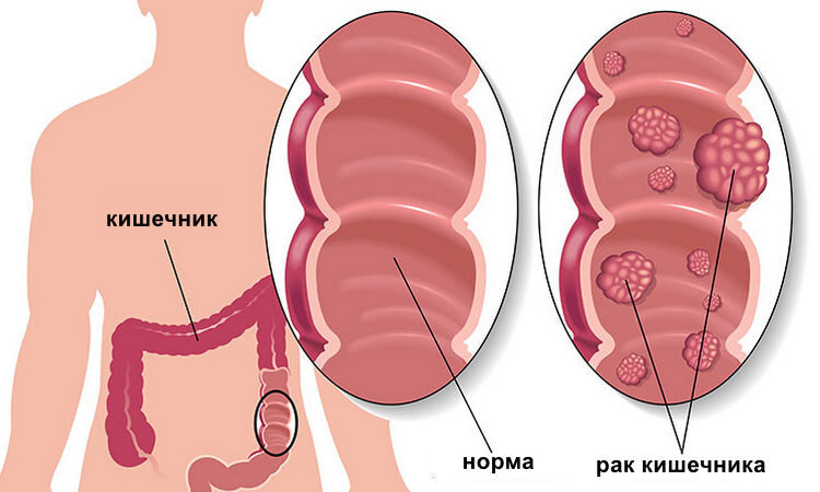 Рак кишечника.