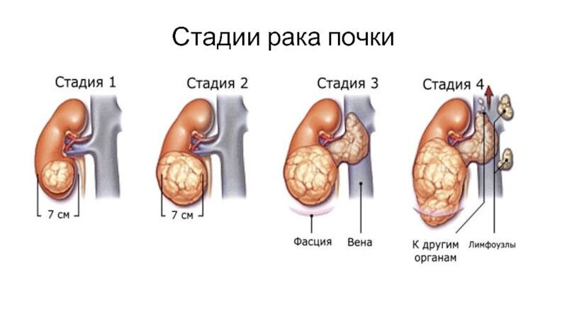 рак почек стадии