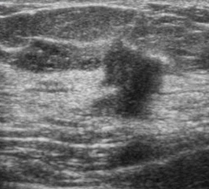 Признаки рака молочной железы на УЗИ 