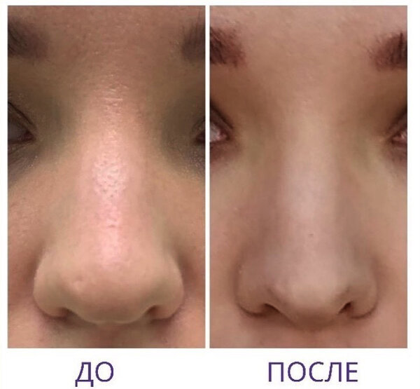 Пример безоперационной ринопластики Фото © Instagram / morozolga_beauty 