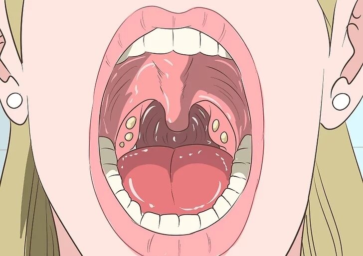 Забитые белым или желтым содержимым лакуны миндалин - один из главных симптомов хронического тонзиллита.