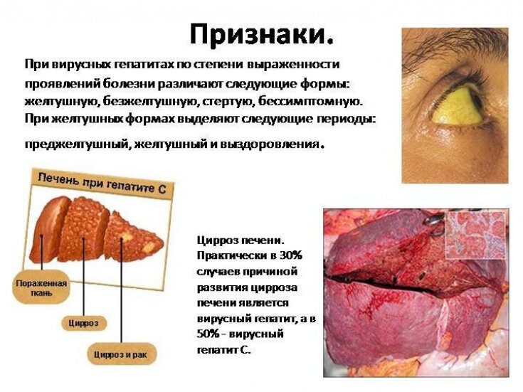 Алкогольная болезнь печени