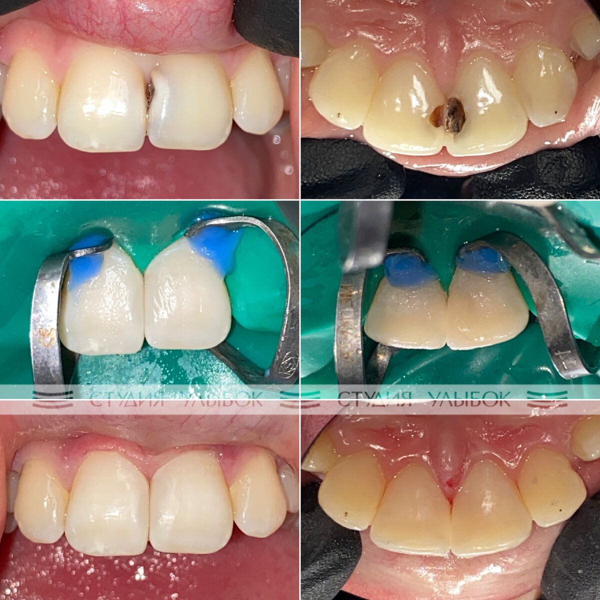 Лечение глубокого кариеса (гиперемии пульпы) и художественная реставрация  передних зубов (резцов) | Стоматология СТУДИЯ УЛЫБОК г. Сочи | Дзен
