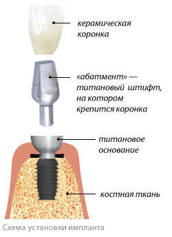 Схема установки импланта