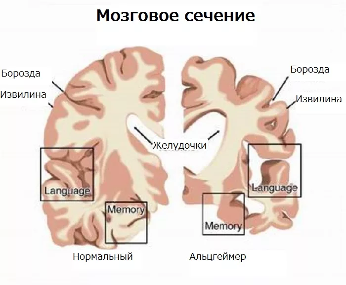 Болезнь Альцгеймера. Болезнь Альцгеймера больные. Альцгеймер память. Альцгеймер симптоматика у детей.