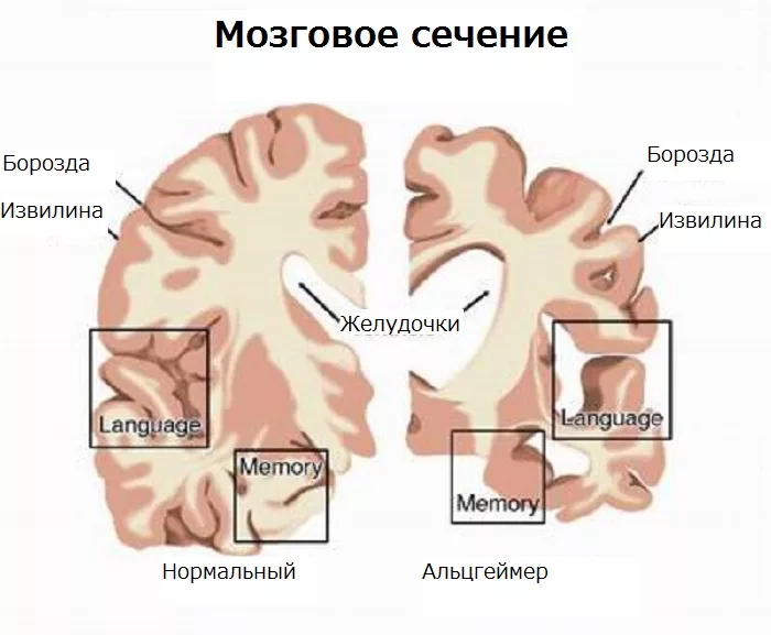 Альцгеймер болезнь. Болезнь Альцгеймера. Болезнь Альцгеймера больные. Альцгеймер память. Альцгеймер симптоматика у детей.