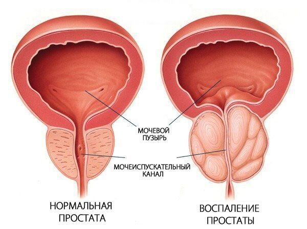 Массаж предстательной железы. Пальцевой массаж простаты в Москве