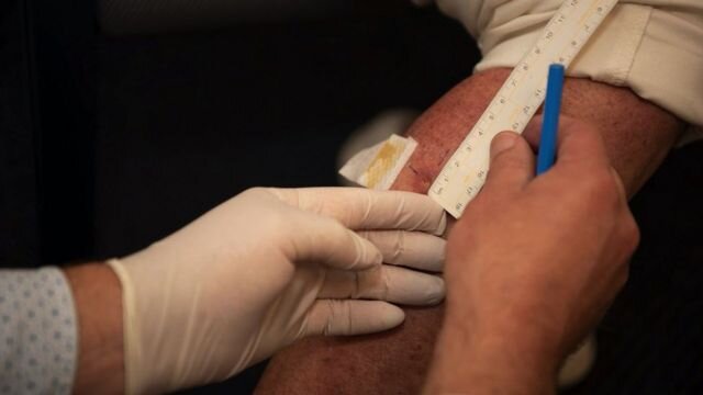 АВТОР ФОТОANNETTE RUZICKAПодпись к фото,Язву Буруле вызывает бактериальная инфекция, которая может уничтожить мягкие ткани, если ее не лечить