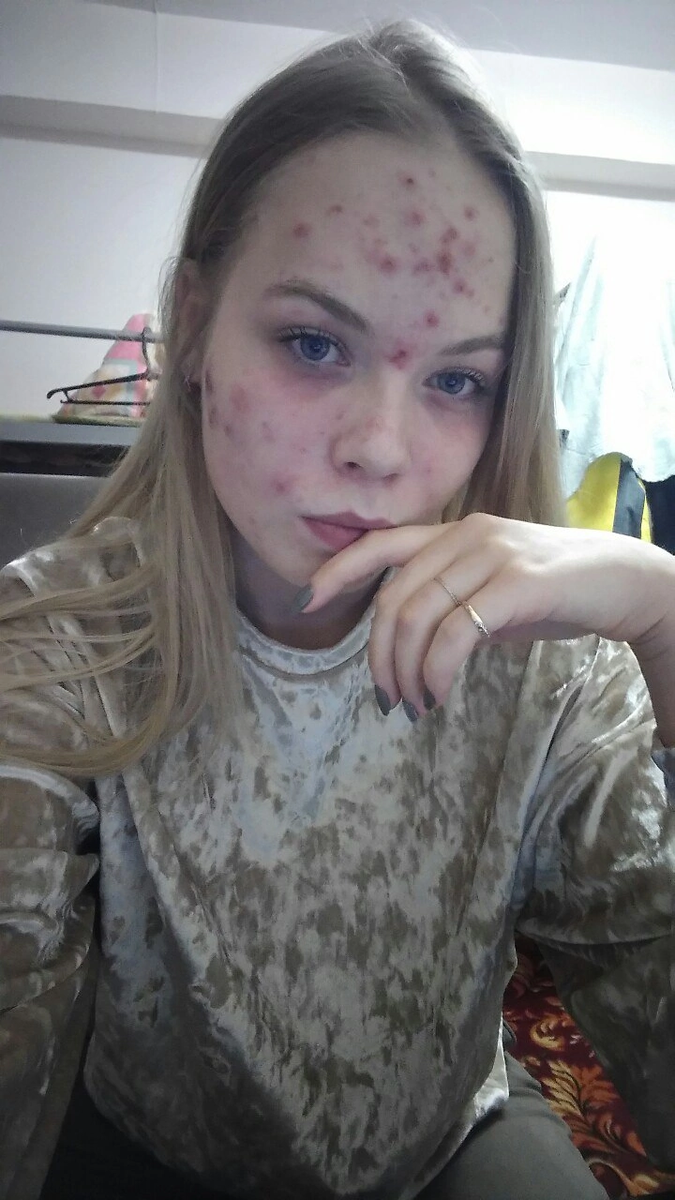 Фото сделано сразу после посещения косметолога. До косметолога состояние кожи было не лучше.