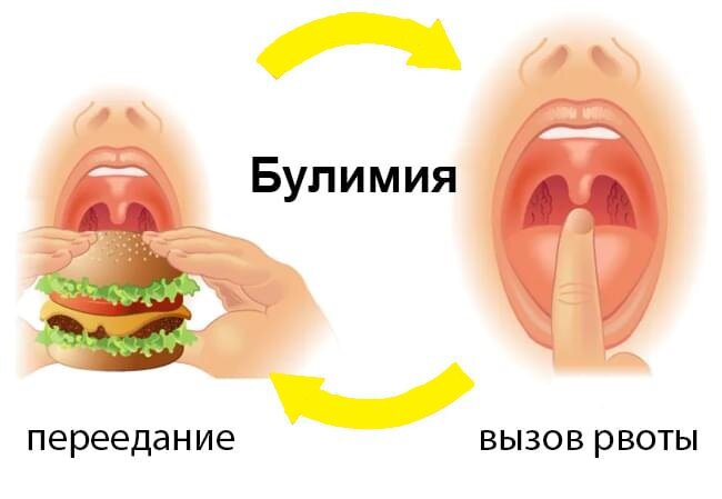 Как избавиться от булимии самостоятельно. Что такое булимия и как излечить.