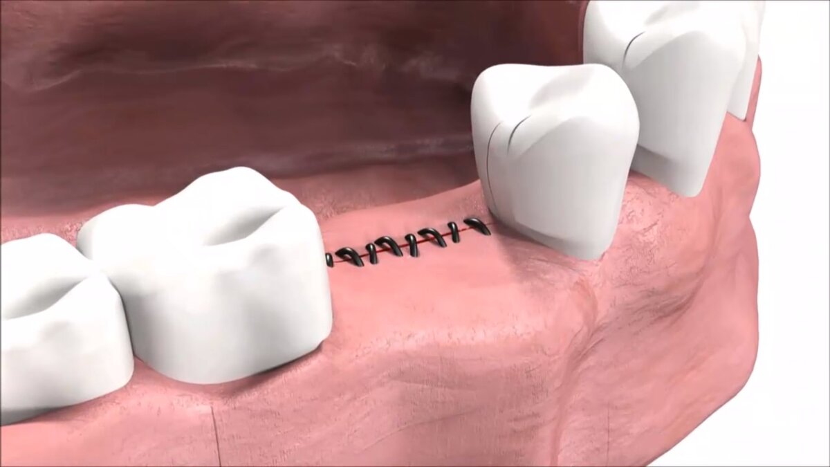 Наложение швов в стоматологии