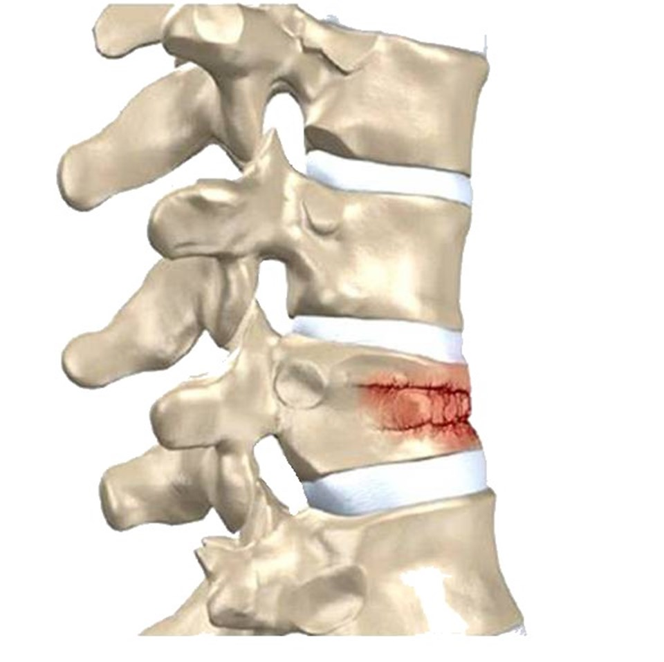 Компрессионный перелом позвоночника поясничного отдела