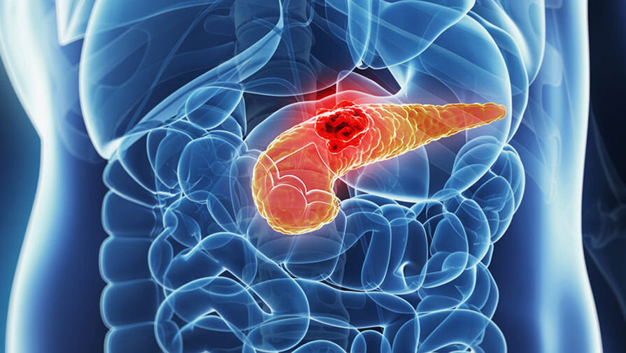 САМЫЙ ЗЛОЙ". Как ищут и чем лечат сегодня рак поджелудочной железы | Будни  онкологической больницы | Дзен