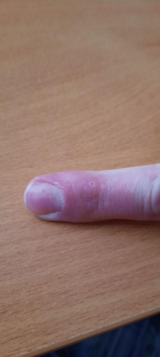 Тот самый палец, через 1.5 недели после действия ᚱ ᛉ ᛒ. Точка на ногте это следы синяка от удара дверным замком 