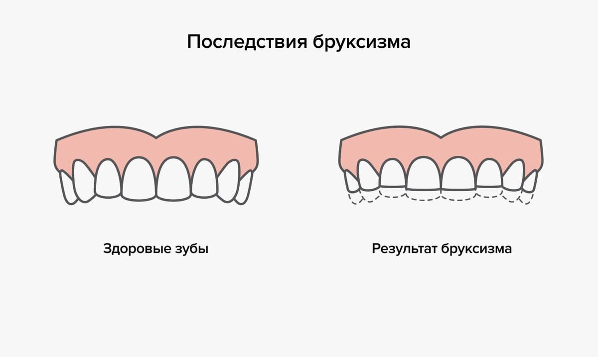 Со временем зубы стираются и приобретают вид ,так сказать, пеньков.