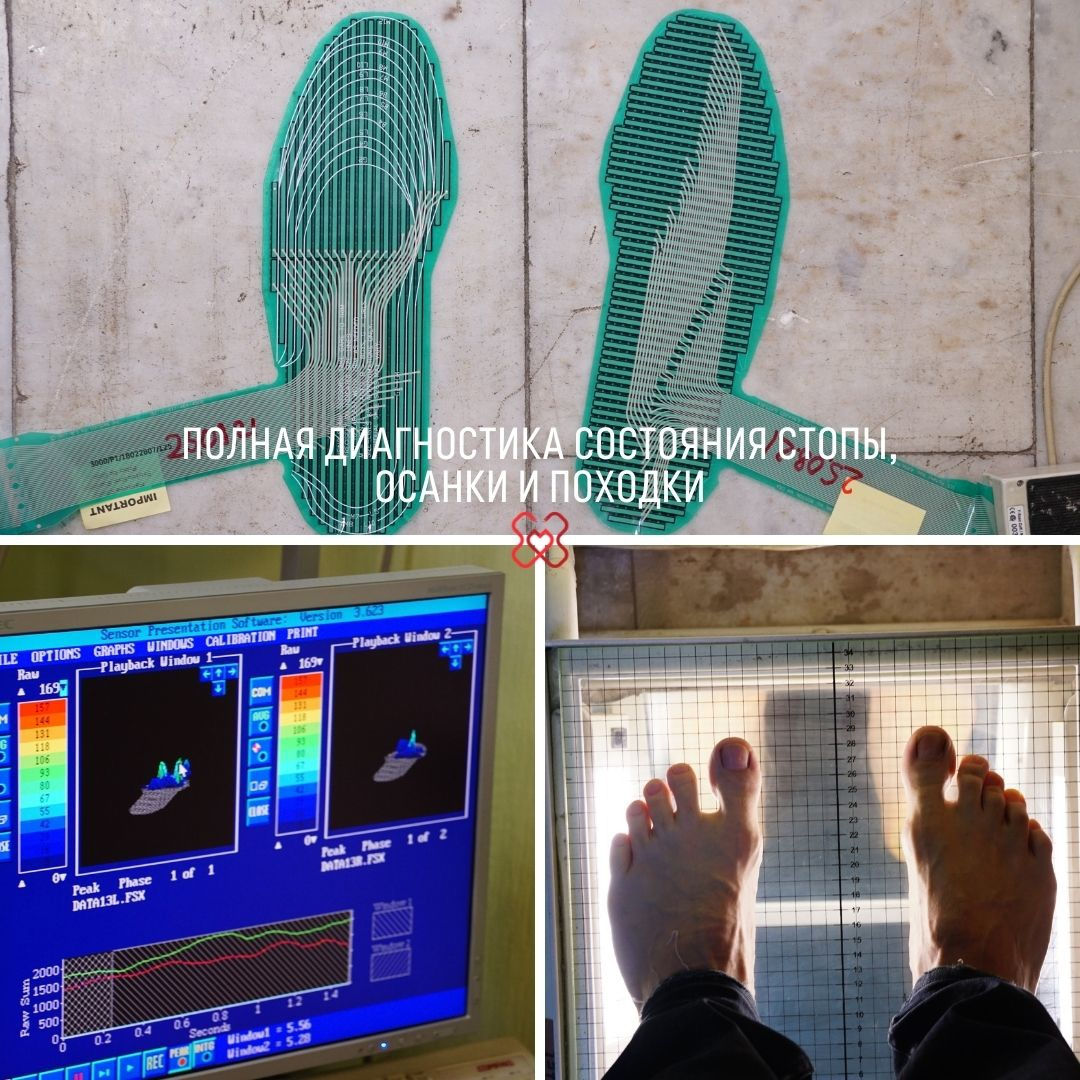 Диагностика состояния стопы, осанки и походки в лаборатории биомеханики ПИМУ
