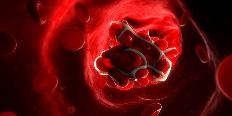 Тромб в просвете сосуда