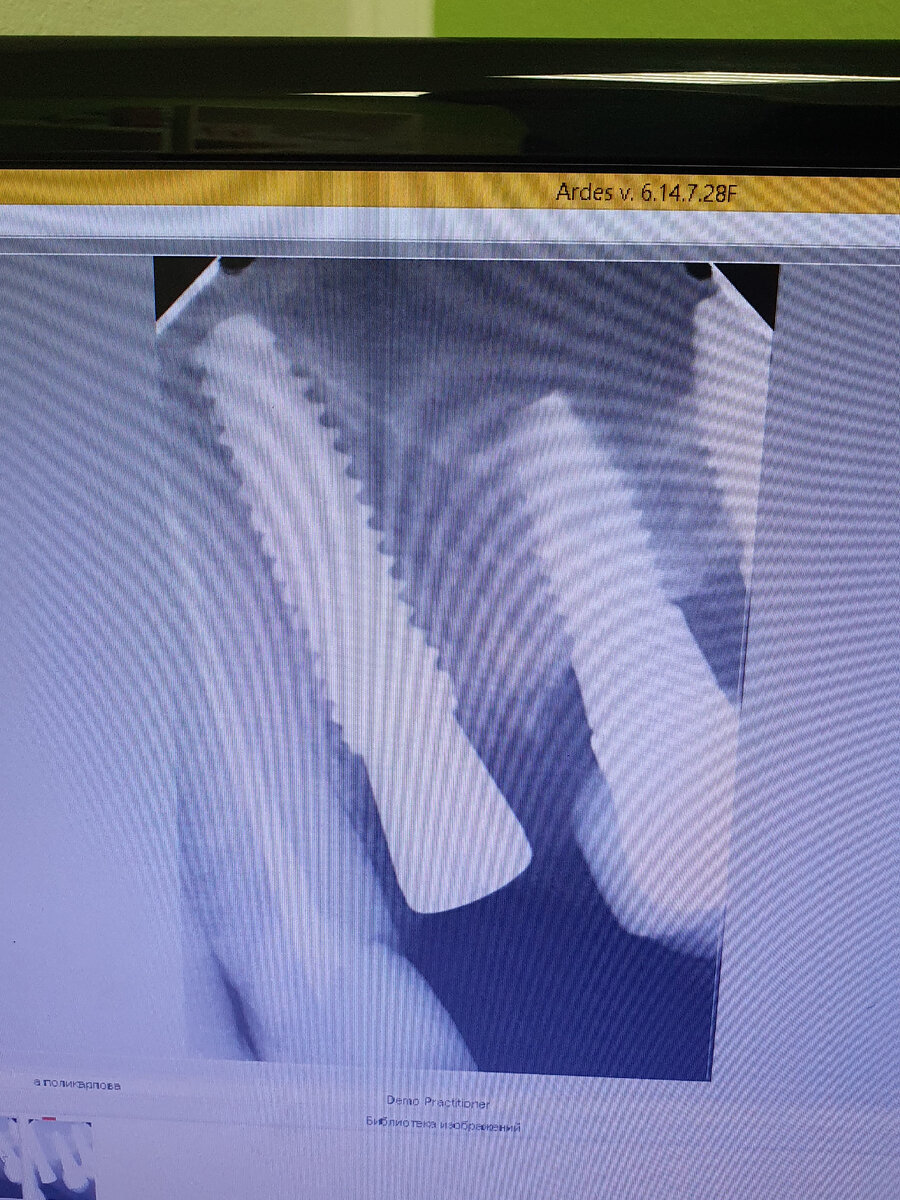 Мы Заботимся о времени наших пациентов ! 

🦷Удаление и постановка импланта в одно посещение! 

Минимум травмы 👌

 Быстрый результат 👌

 🧚‍♀️Гаврилова Юлия Юрьевна 🧚‍♀️