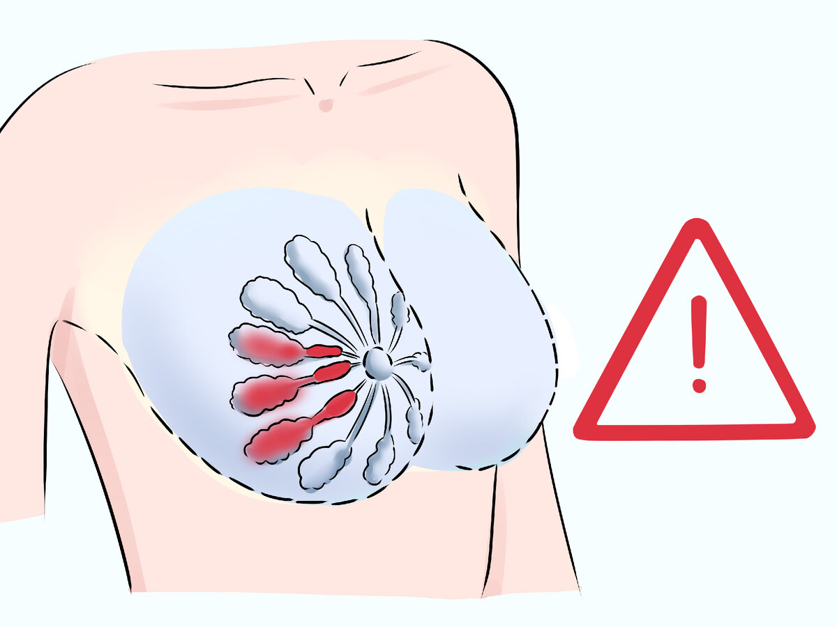 грудь застой молоке фото 2