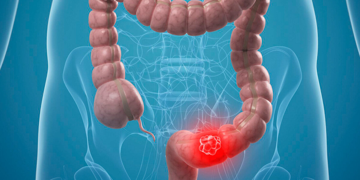 Рак толстой кишки картинки