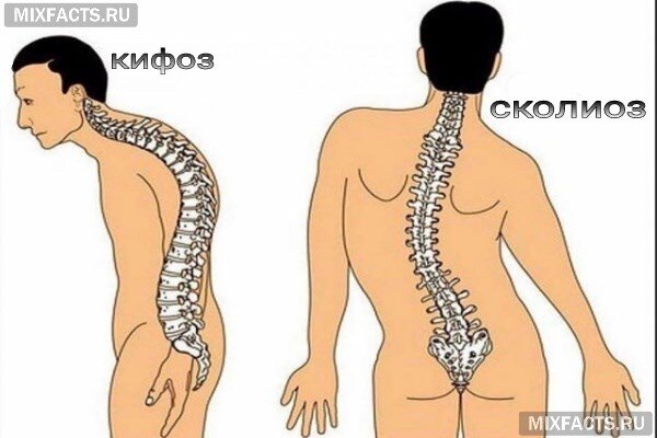 Почему бывает искривления позвоночника ?