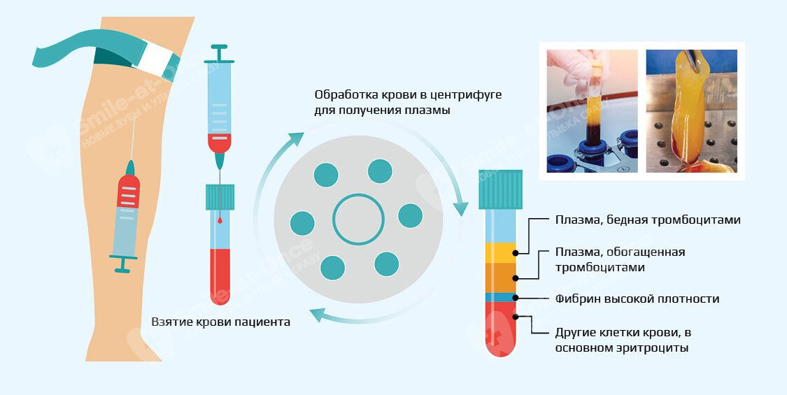 PRF-мембрана имеет вид плотного желеобразного сгустка, который можно делить на части и прикладывать к ранам. Фото: Smile-at-Once.ru 