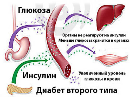Последствия диабета второго типа.