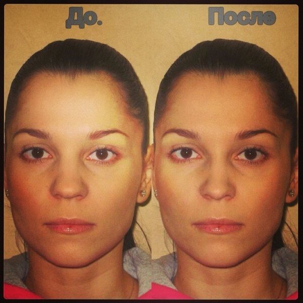 Rhinoplasty Before & After Photos, Beverly Hills LA Rhinoplasty