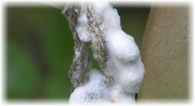 Этапы развития болезни: