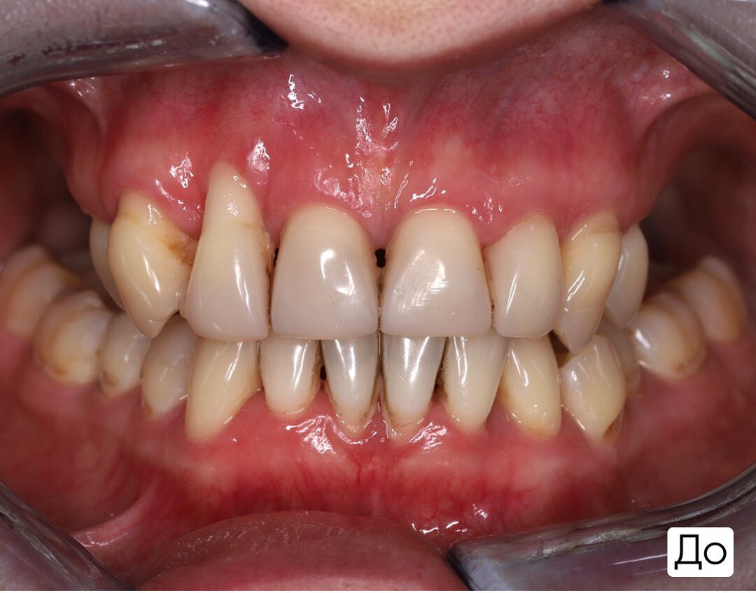 Воспаление десен и подвижность всех зубов