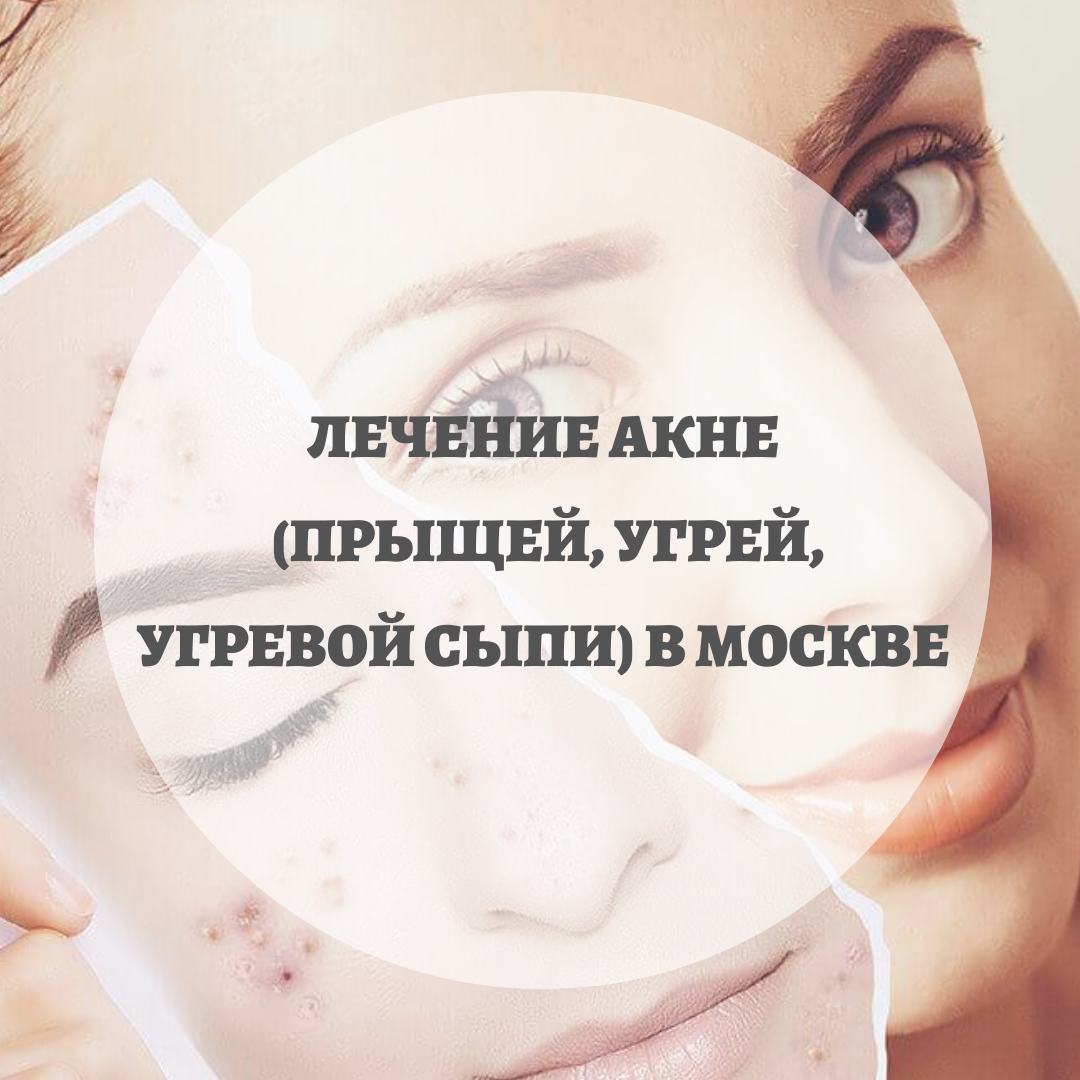 Наша клиника НМИЦ эндокринологии – ведущее медицинское учреждение России, в котором осуществляется комплексное лечение и устранение угревой болезни (прыщей), с учетом причин ее возникновения. Мы поможем вам убрать прыщи и их последствия на спине, лице и других участках кожи.