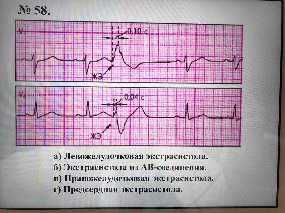 на пропедевтике был комбинированный экзамен: отвечали устно и определяли патологию на ЭКГ. По количеству материала объемный экзамен, но сам предмет невероятно интересный