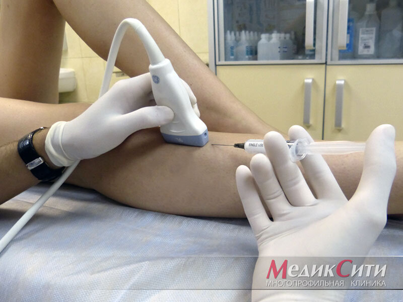 Пенная склеротерапия