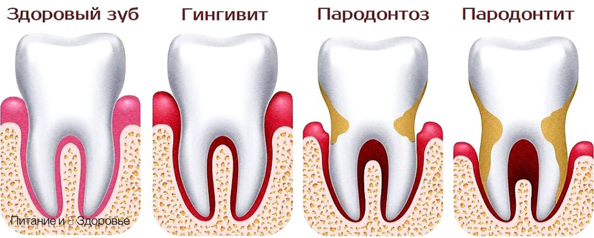 Почему зубы отличаются. Гингивит пародонтит пародонтоз. Гингивит пародонтит периодонтит. Пародонтит патанатомия. Периодонтит пародонтит различия.