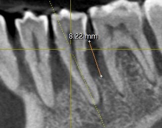убыль кости 