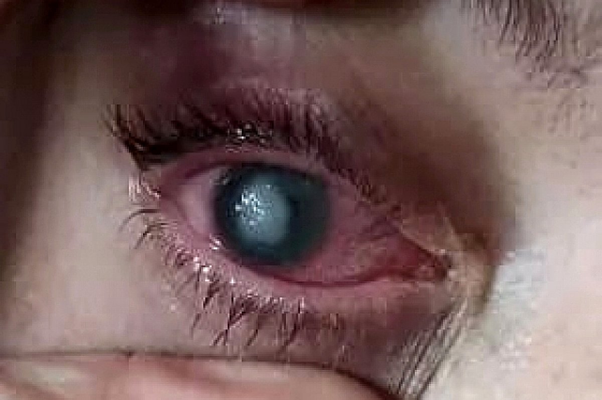    Жительница Дона Светлана Авдеева потеряла зрение после лечения в местной клинике.