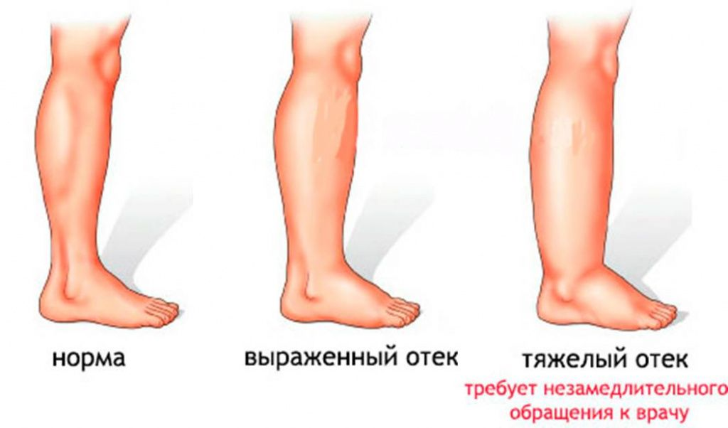 Отечность ног: причины и современные методы лечения отека ног