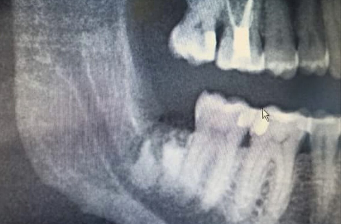 НА ФОТО: ПРИ УДАЛЕНИИ ЗУБА МУДРОСТИ ПРОИЗОШЕЛ ПЕРЕЛОМ КОРНЕЙ, КОРНИ ЗАСТРЯЛИ В ЧЕЛЮСТИ.