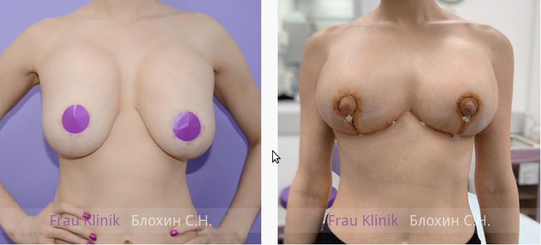 Повторная маммопластика. Исправление результата пластики груди, сделанной НЕ в нашей клинике. Время после операции: 1 сутки