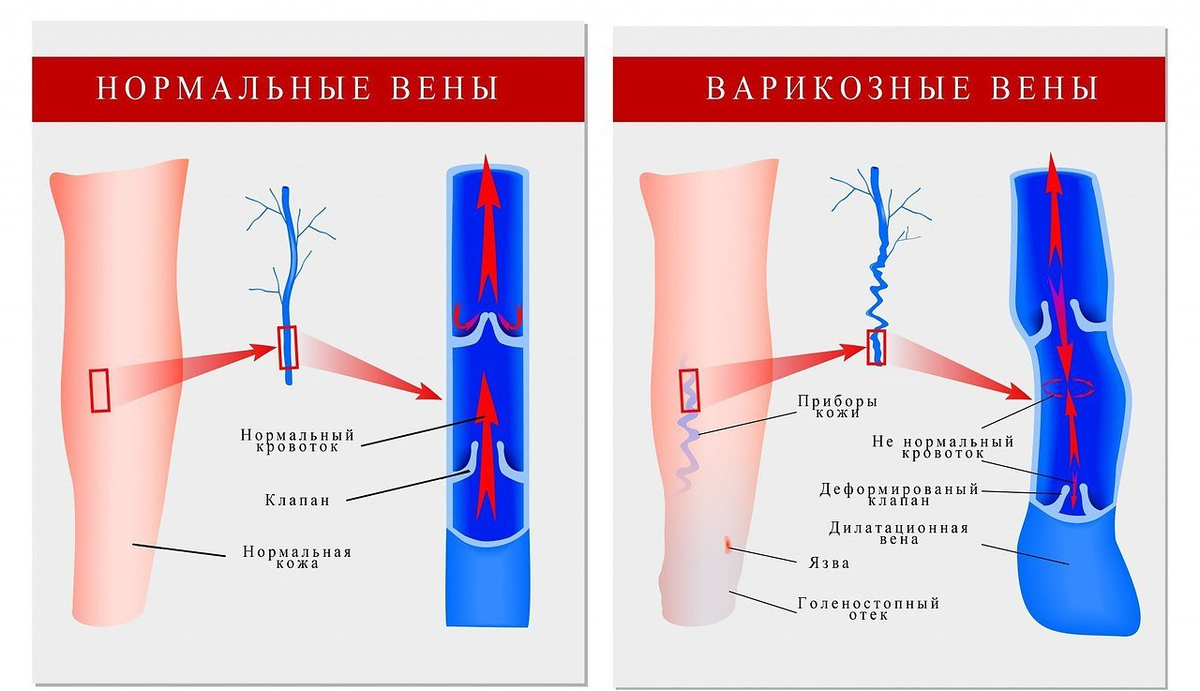 Тромбофлебит варикозных вен. Нормальная и варикозная Вена. Клапанный аппарат нормальной и варикозной вены. Варикозное расширение вен (ВРВ) нижних конечностей.