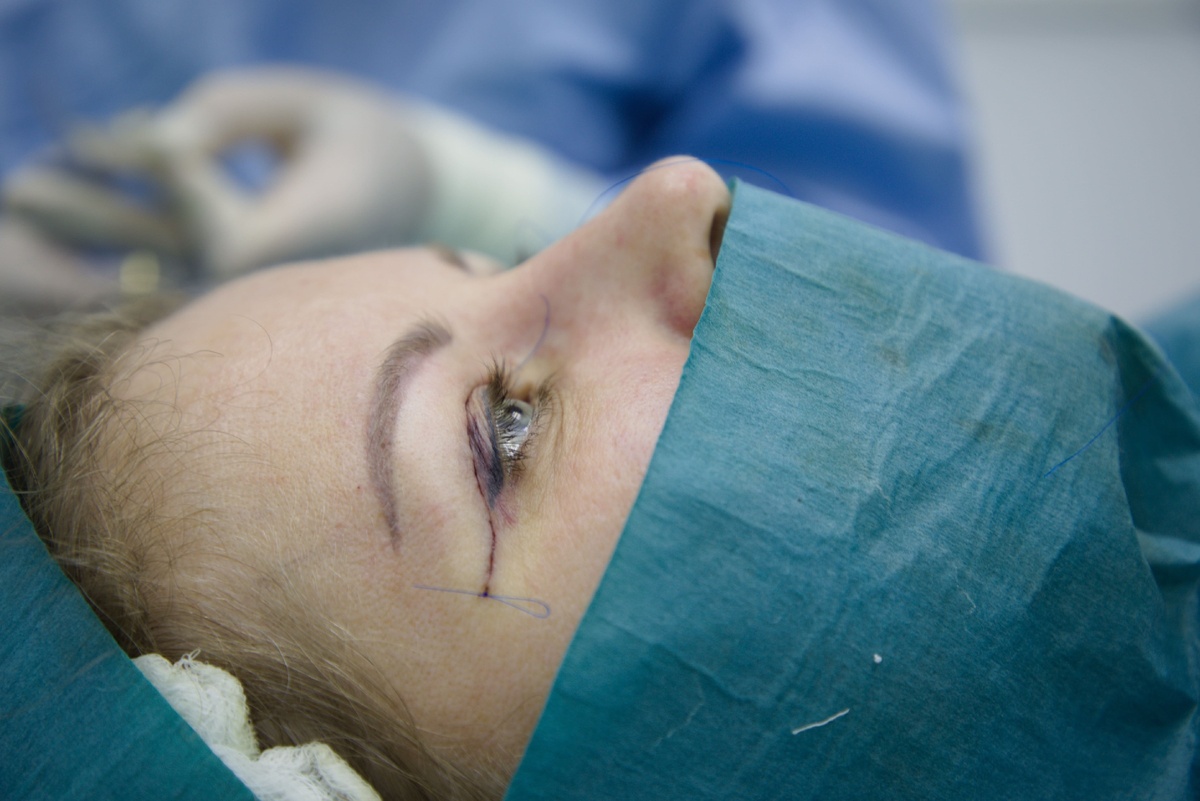 Фото с операции блефаропластики в Клинике Максима Рослякова