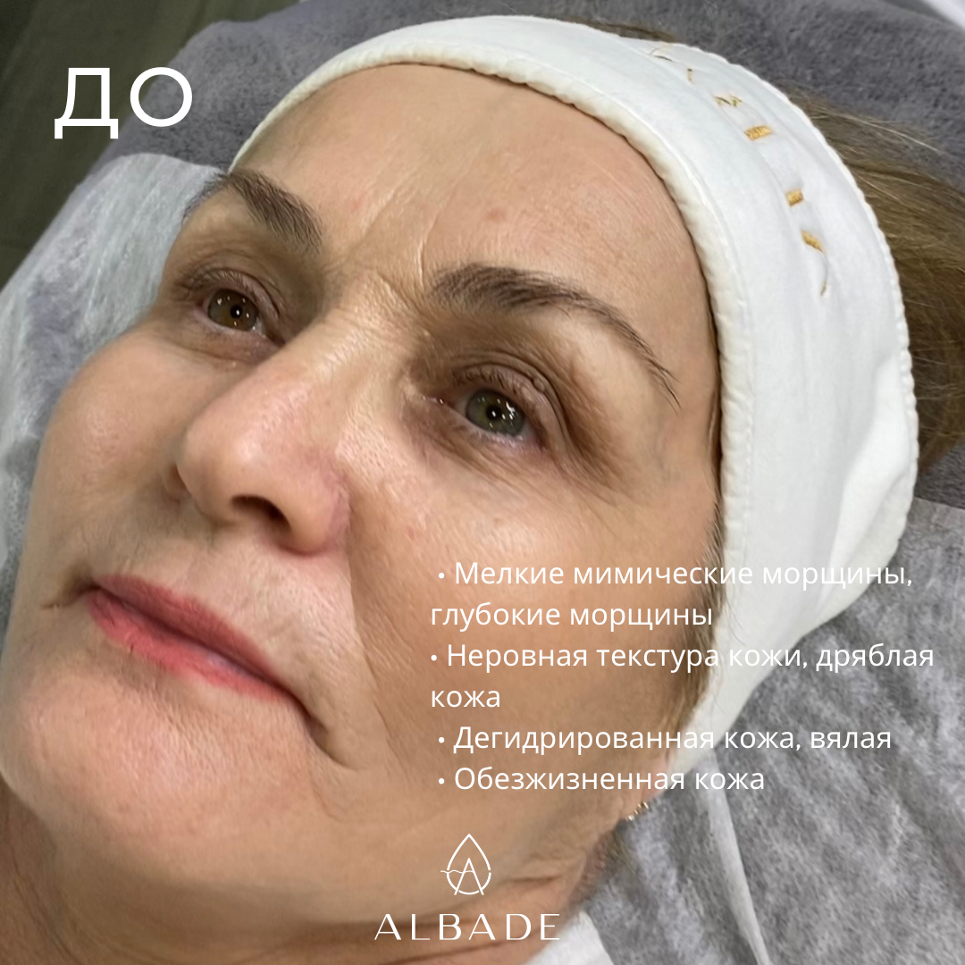 Процедура Forever Yong