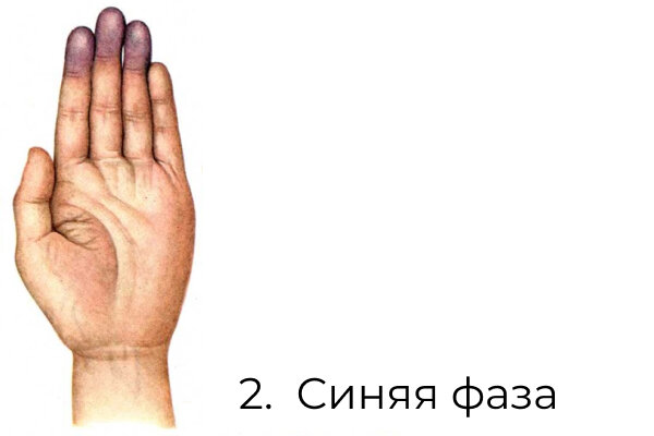 Болезнь Рейно: общие сведения, симптомы, диагностика и лечение | О ...