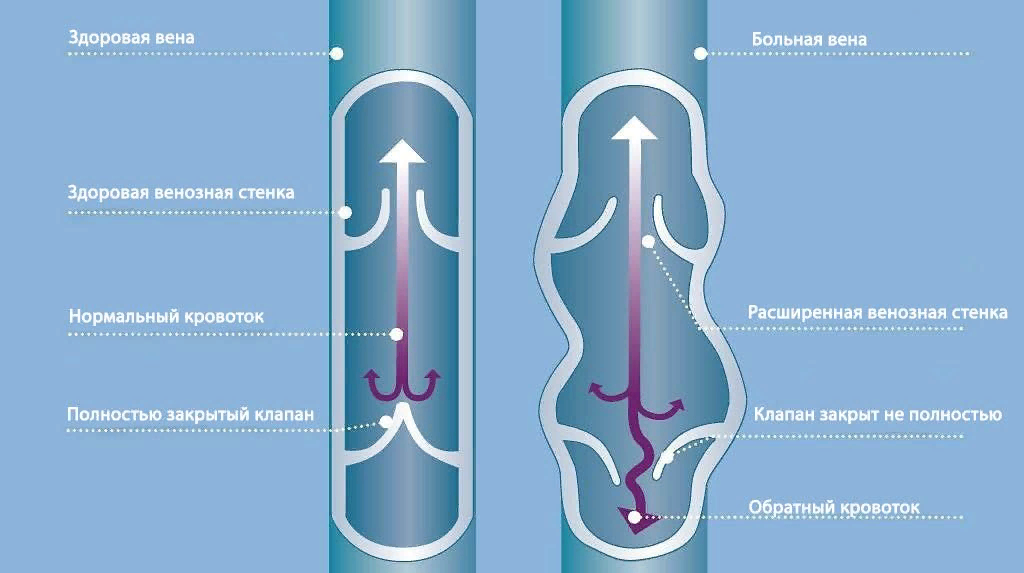 Вена при варикозе строение. Строение вены человека клапаны. Строение клапанного аппарата вен. Строение венозного клапана.