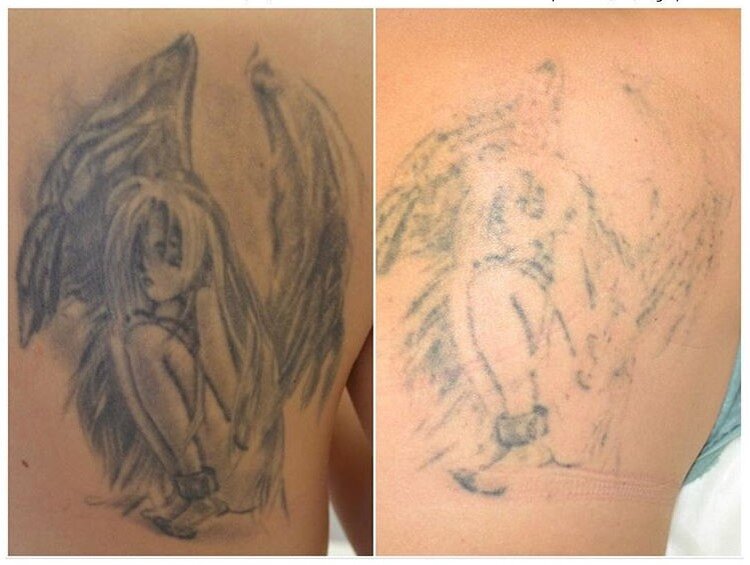 Сделана 1 процедура удаления тату на аппарате Picosure