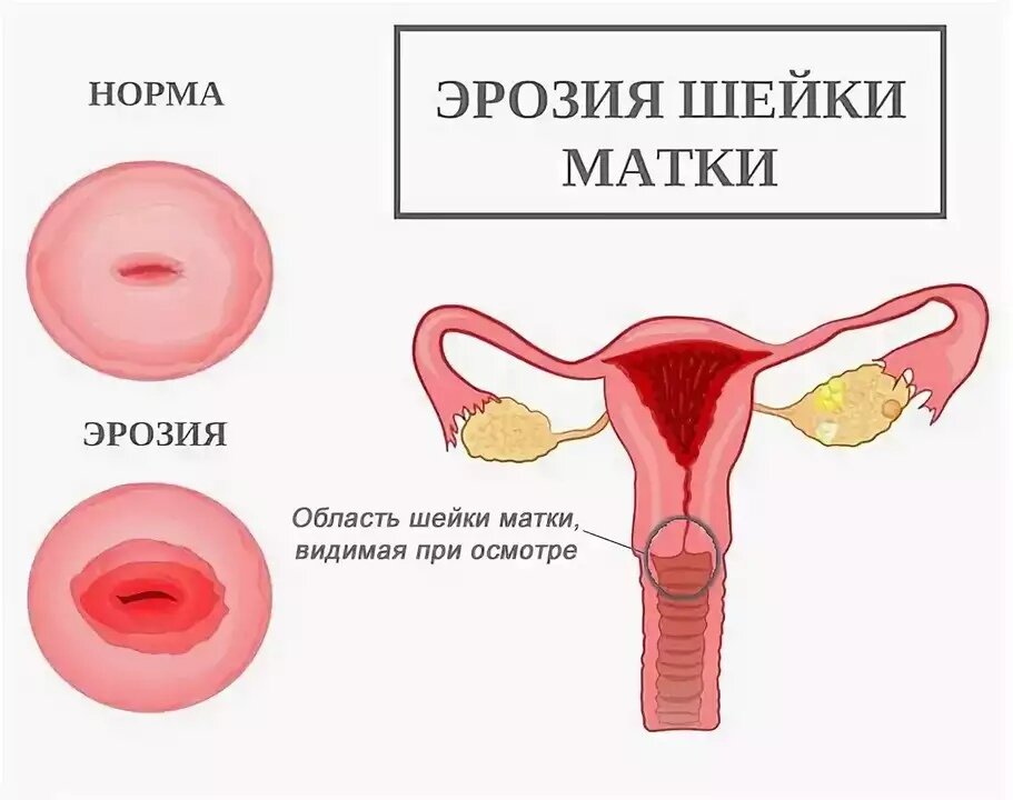 спринцевание корой дуба — 25 рекомендаций на дачапокарману-казань.рф