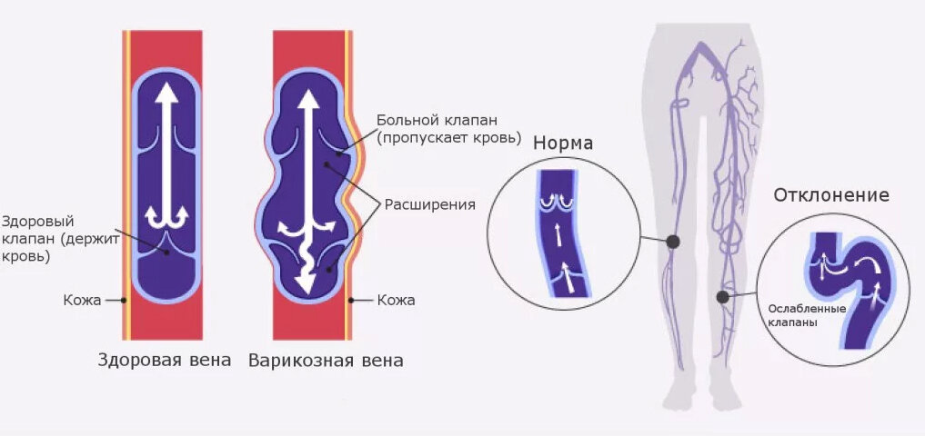 Варикозное расширение вен в наглядных картинках