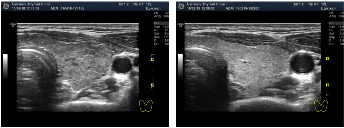 Пример восстановления щитовидной железы при болезни Грейвса в Клинике щитовидной железы доктора А.В. Ушакова. Слева до лечения:, справа - после лечения. Американские коллеги считают это состояние неизлечимым. Понятно почему... Если не лечить, то и результата не будет.