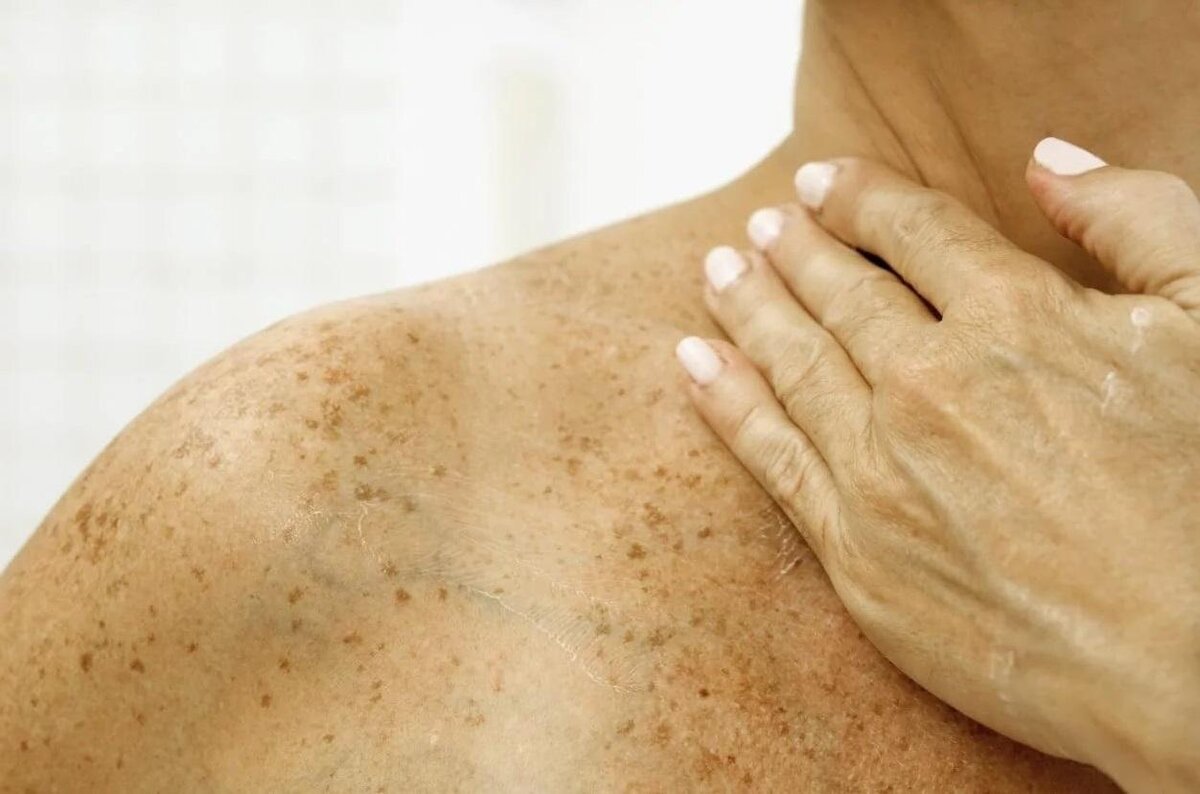 Пигментные пятна - результат долгих "солнечных ванн"