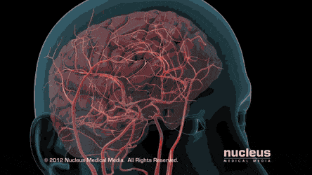 Окклюзия тромбом сосуда,  выключает его из кровотока. Результат - некроз той части мозга (или другого органа), которую он кровоснабжает